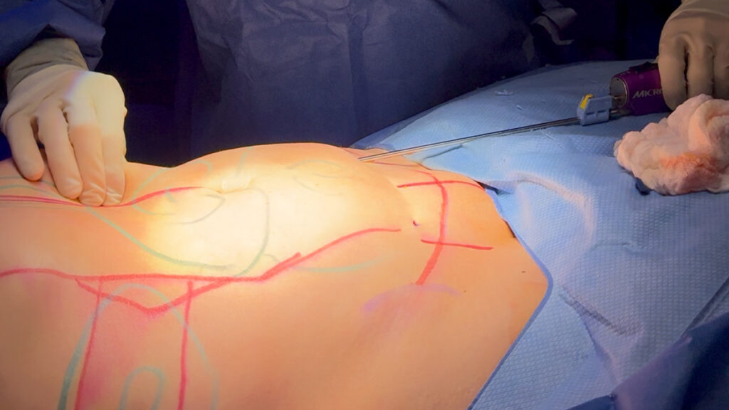 Beyond the Bruising: A Clear Guide to the Lipo Healing Journey